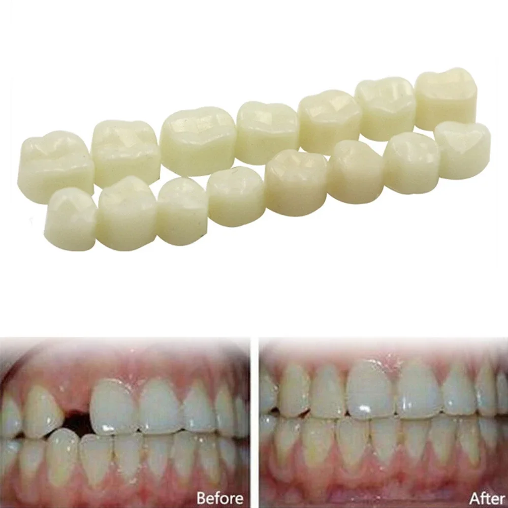 Фасетите за зъби от ультратонкой избелваща смола, Предната горна временна корона, порцелан стоматологичен материал за грижа за устната кухина